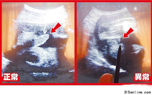 超聲波可看到胎兒生殖器,左圖箭頭處為28周正常男嬰生殖器:右圖箭頭處為異常男嬰28周時生殖器畫面。圖片來源:臺灣媒體 超聲波可看到胎兒生殖器,左圖箭頭處為28周正常男嬰生殖器:右圖箭頭處為異常男嬰28周時生殖器畫面。圖片來源:臺灣媒體